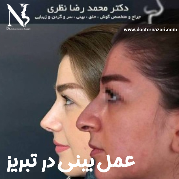 رضایت از عمل بینی فقط به کوچک‌شدن بینی محدود نمی‌شود